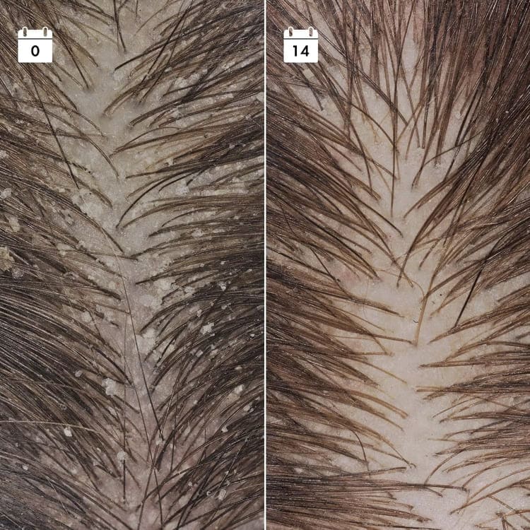 ANTI-DANDRUFF SERUM (SÉRUM ANTICASPA REINCIDENTE)